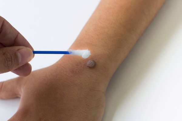 手术增大增粗阴茎全过程