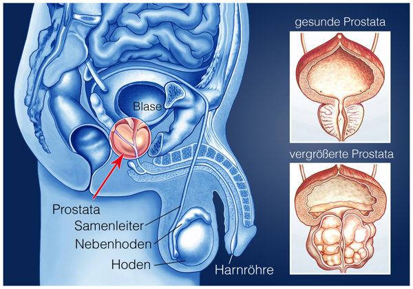 正常的前列腺应该是多大